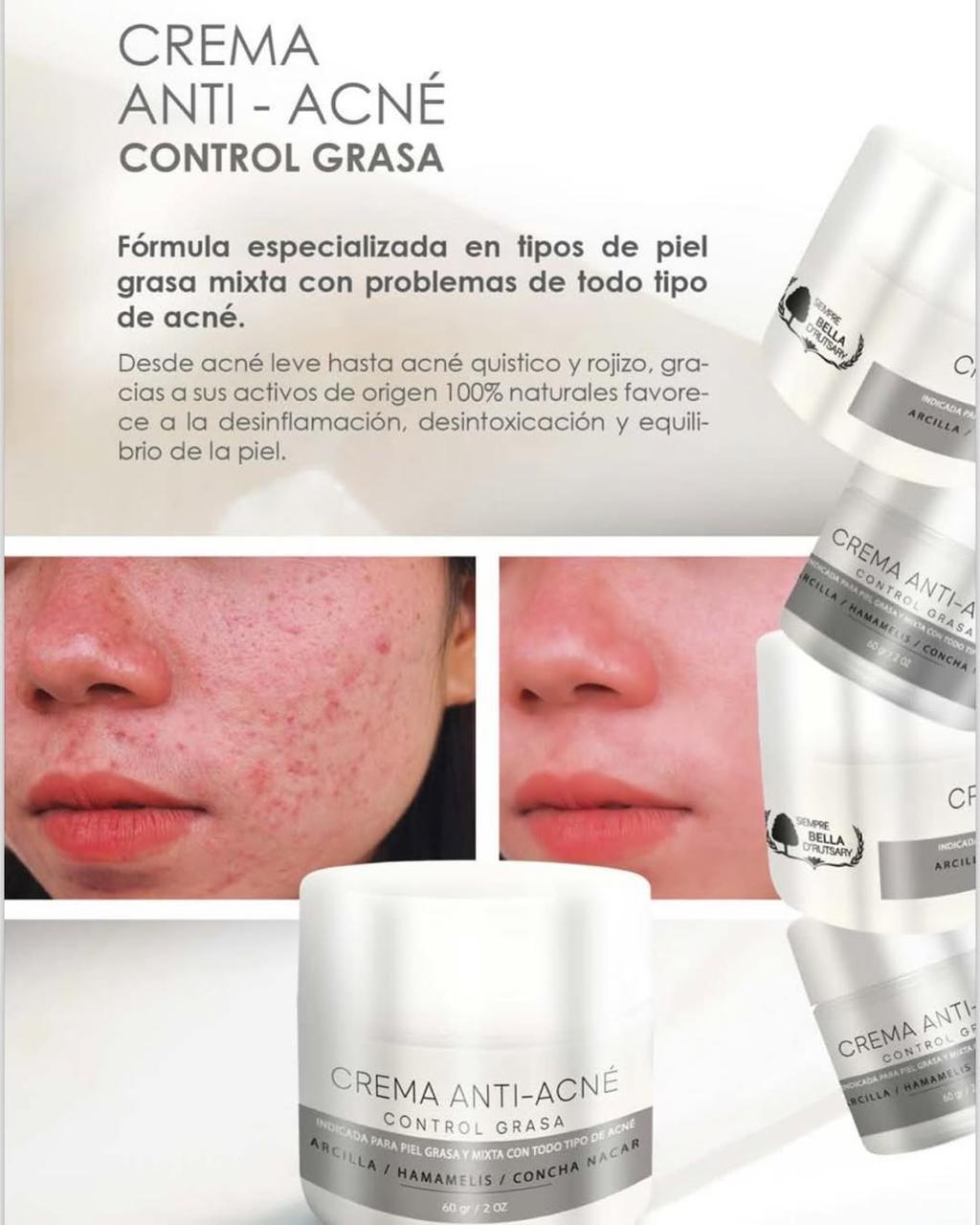 Crema anti-acné